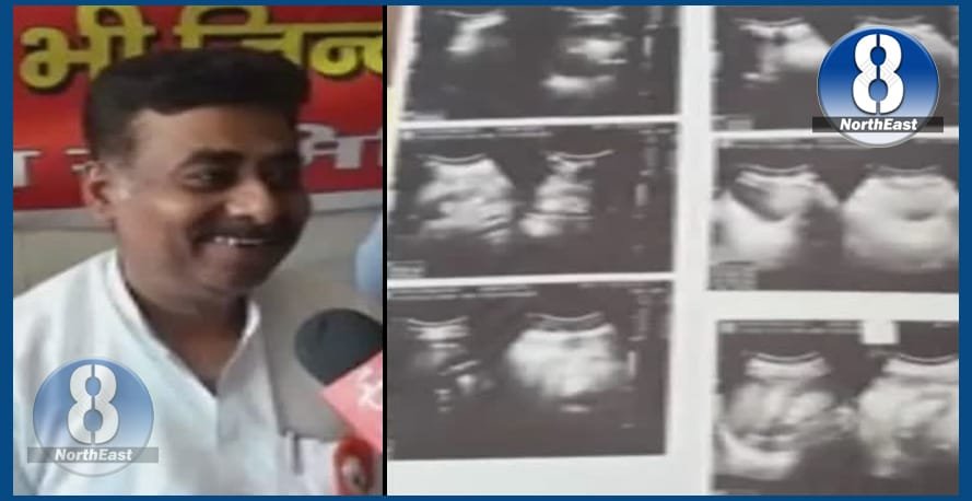 আশ্বৰ্যকৰ! ব্যক্তি এজনেই, কিন্তু শৰীৰত বৃক্ক আছে তিনিটা… 1 susil gupta