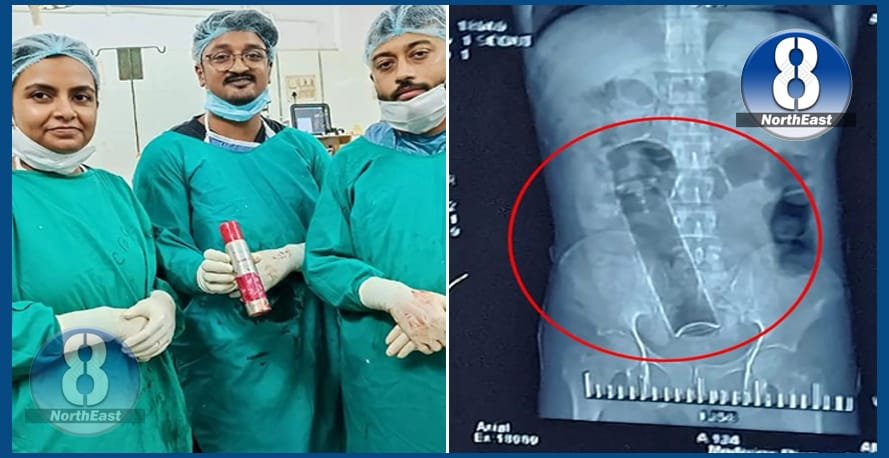 আশ্বৰ্যকৰ! যুৱকৰ গুহ্যদ্বাৰত আৱদ্ধ হৈ আছিল ডিঅ’ড্ৰেণ্টৰ বটল, অস্ত্ৰোপচাৰৰ জৰিয়তে বাহিৰ কৰিলে চিকিৎসকে 1 deo